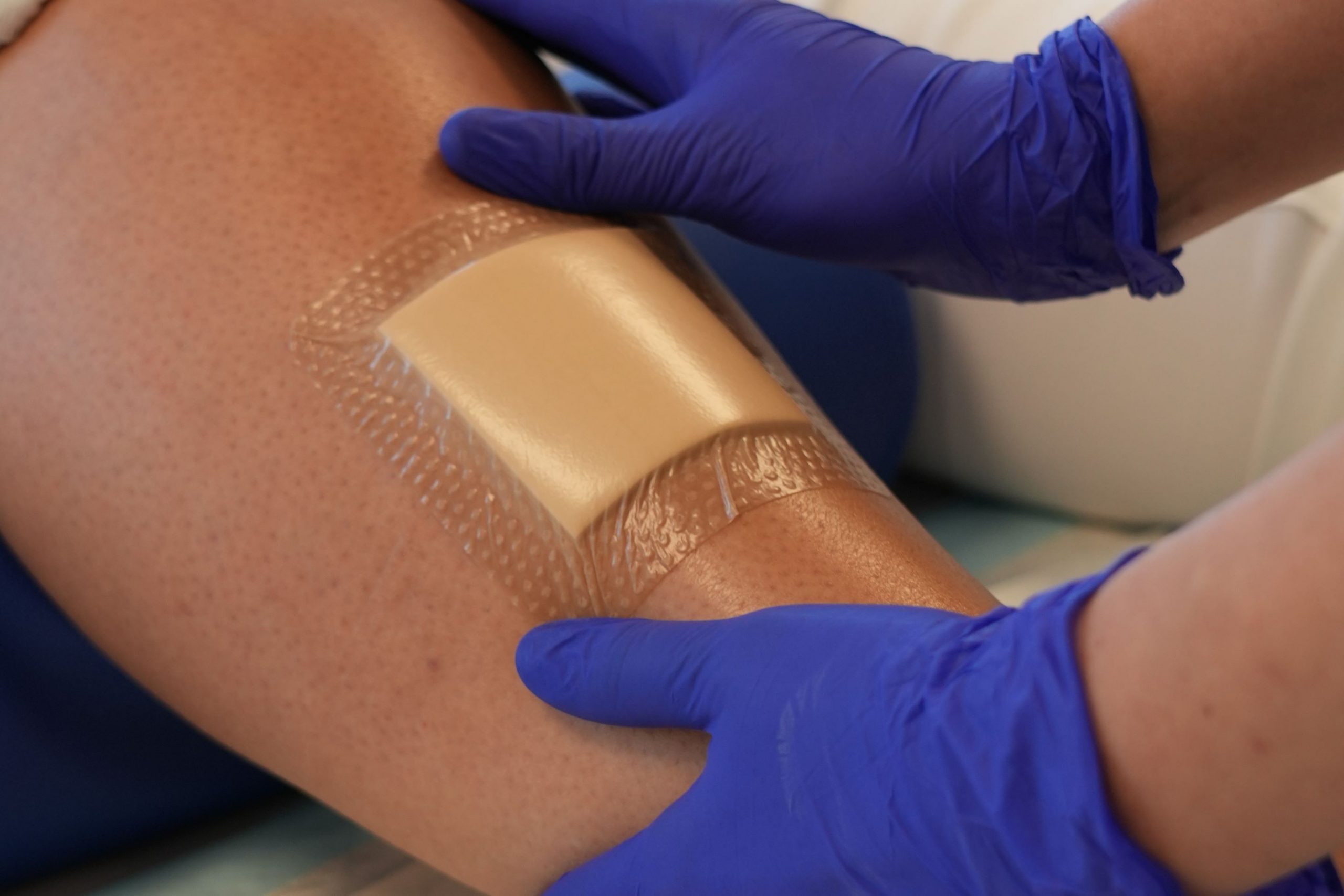 Mehr über den Artikel erfahren Die HKP-Richtlinie: Der Schlüssel zur besseren Versorgung von chronischen und schwer heilenden Wunden