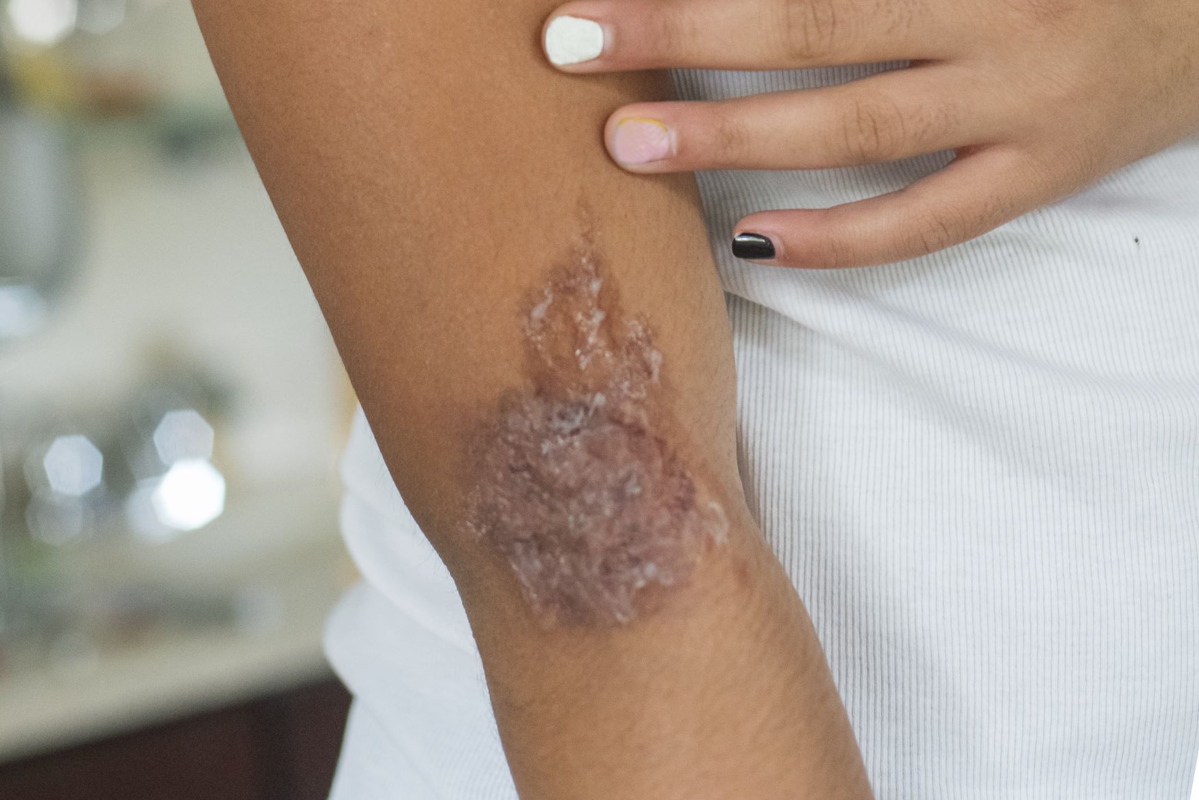 Mehr über den Artikel erfahren Wenn Krebs Wunden hinterlässt