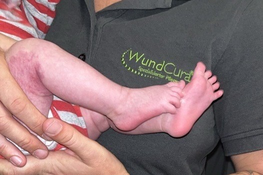 Mehr über den Artikel erfahren Unsere jüngste Patientin bei WundCura